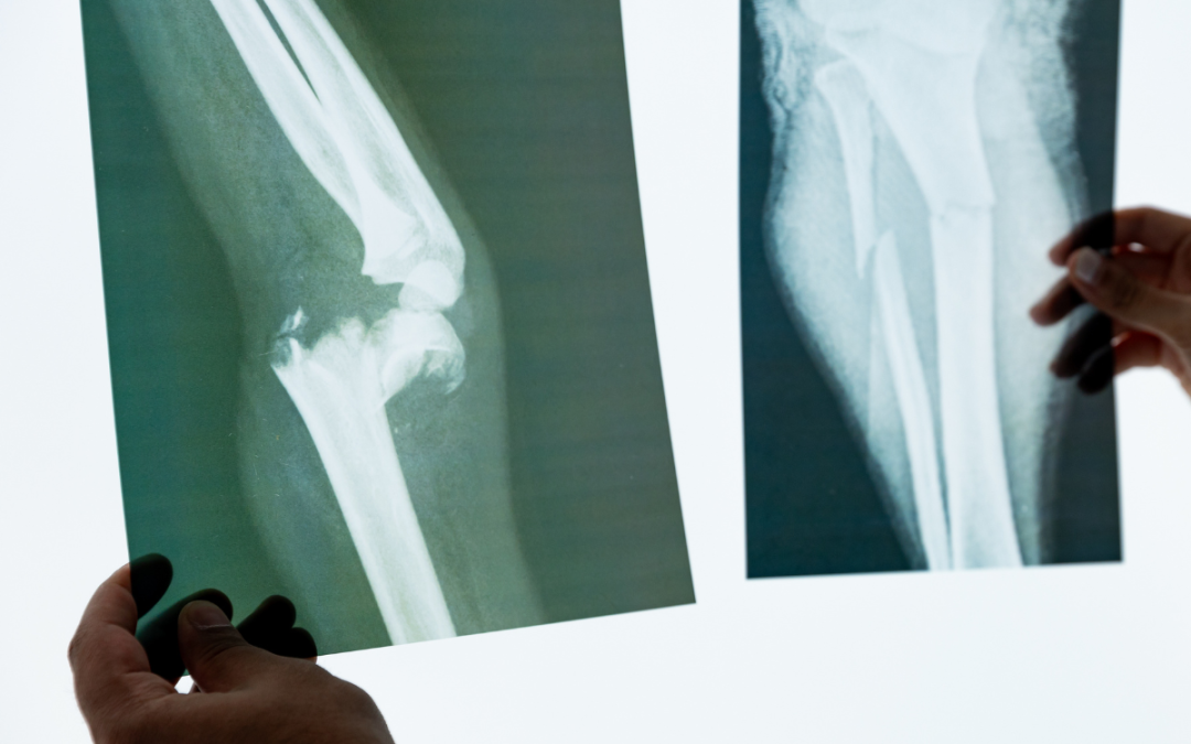 Titanium Bar for Orthopedic Implant Manufacturing in Minneapolis, Minnesota