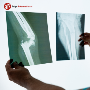 Titanium Bar for Orthopedic Implant Manufacturing in Minneapolis, Minnesota 